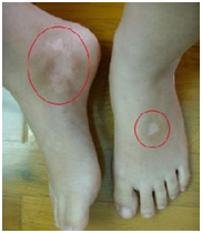 白癜风症状