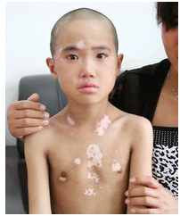 儿童白癜风症状