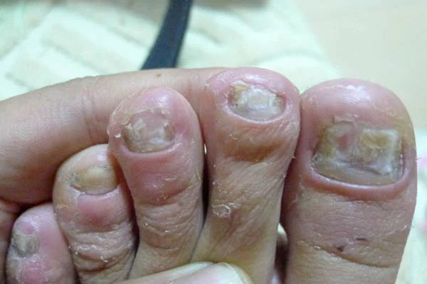 台江治疗灰指甲