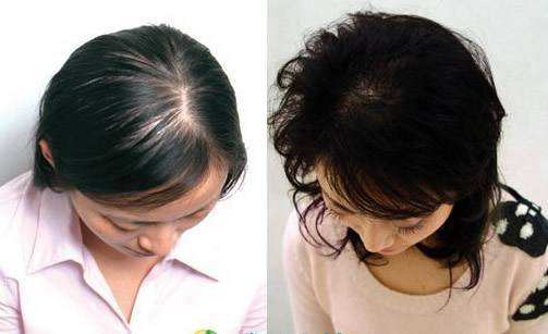 脱发期间会有哪些症状显现?