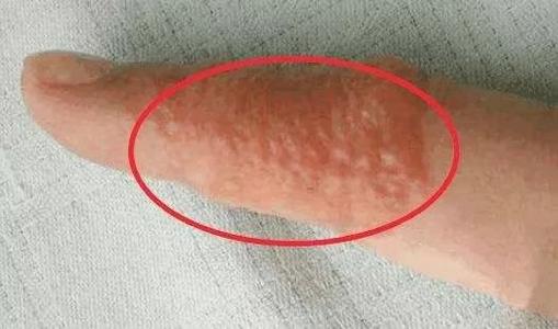 汗疱疹发生的原因有哪些?