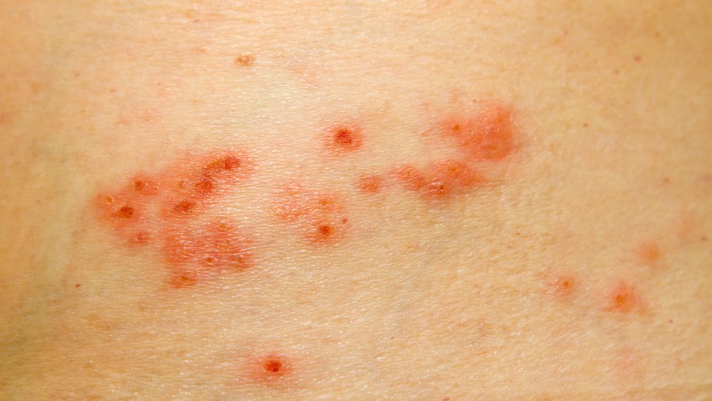 患上扁平疣有哪些忌讳