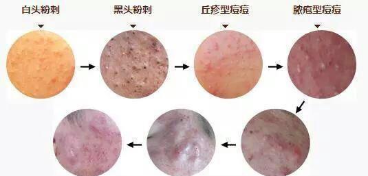 福州华研讲解青春痘的六大类型及症状