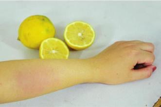 日光性皮炎表现症状是什么?