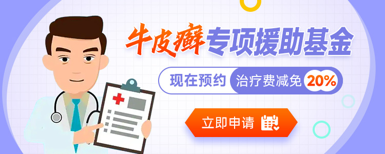 福州治疗银屑病要多少钱