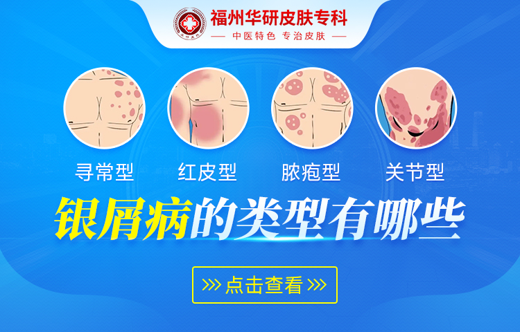 福州市牛皮癣门诊专治掌跖脓疱病