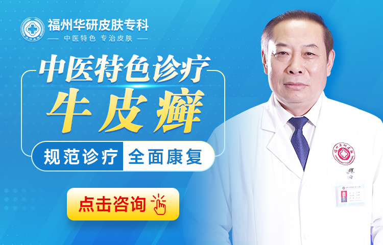福州哪里能治牛皮癣