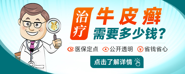 福州治疗牛皮癣价格多少