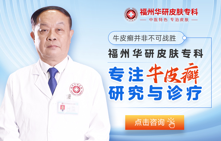 福州看牛皮癣到哪里好